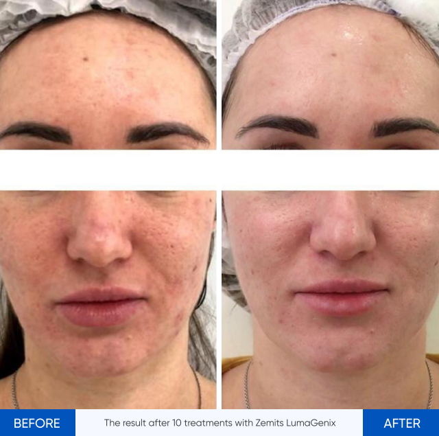 Zemits LumaGenix PDT Perangkat Terapi Cahaya LED Profesional