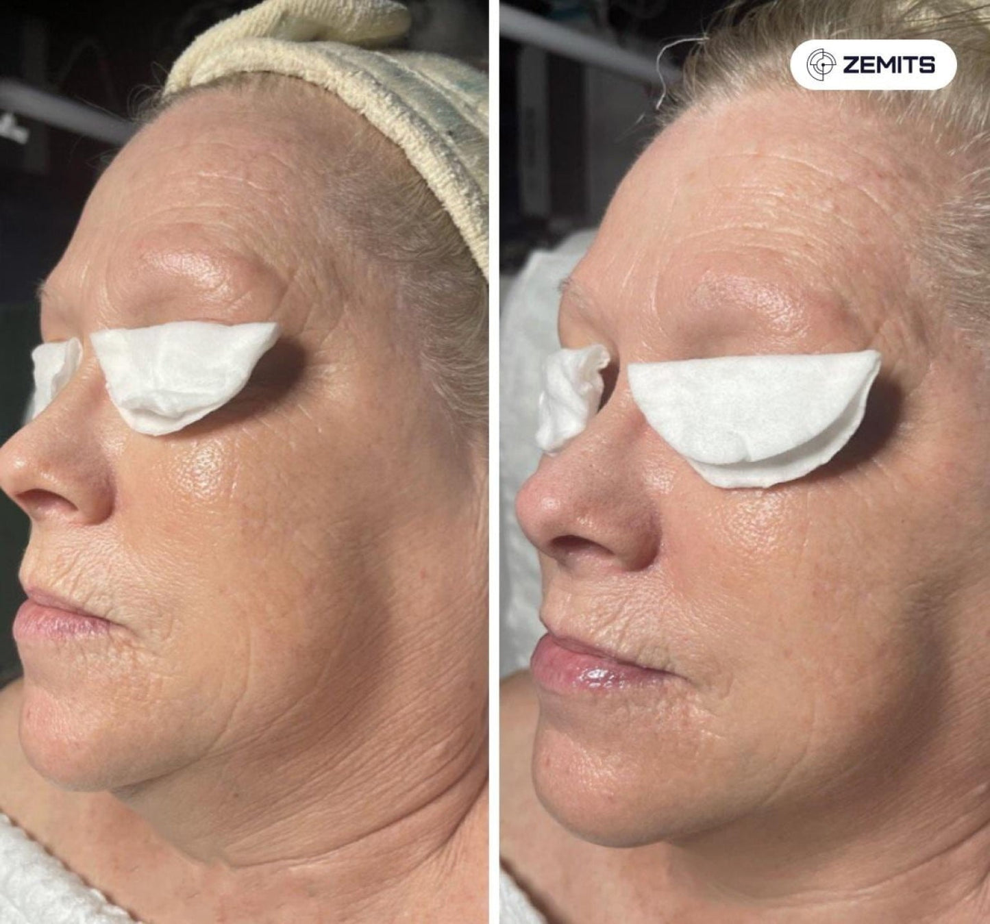 Zemits Klein EL Sistem Elektroporasi