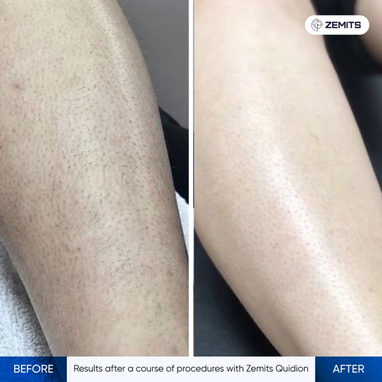 Zemits Quidion Laser Diode Untuk Penghilangan Bulu