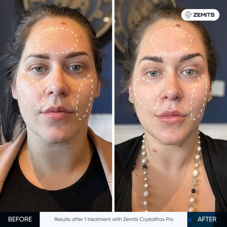 Sistem RF Fraksional Non-Invasif Zemits CrystalFrax PRO