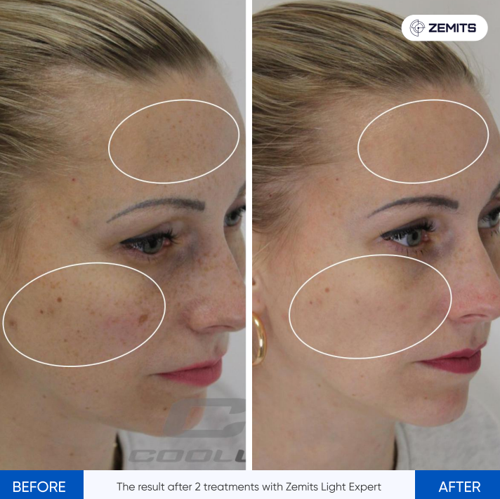 Zemits Light Expert 2.0 Mesin Laser IPL