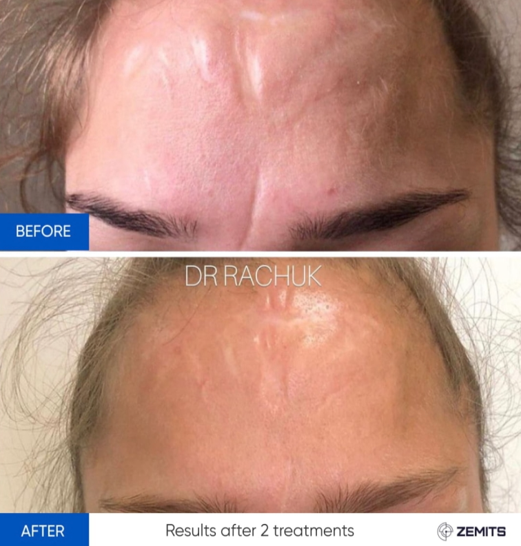 Zemits CarbonFrax Pro: Laser Fraksional CO2