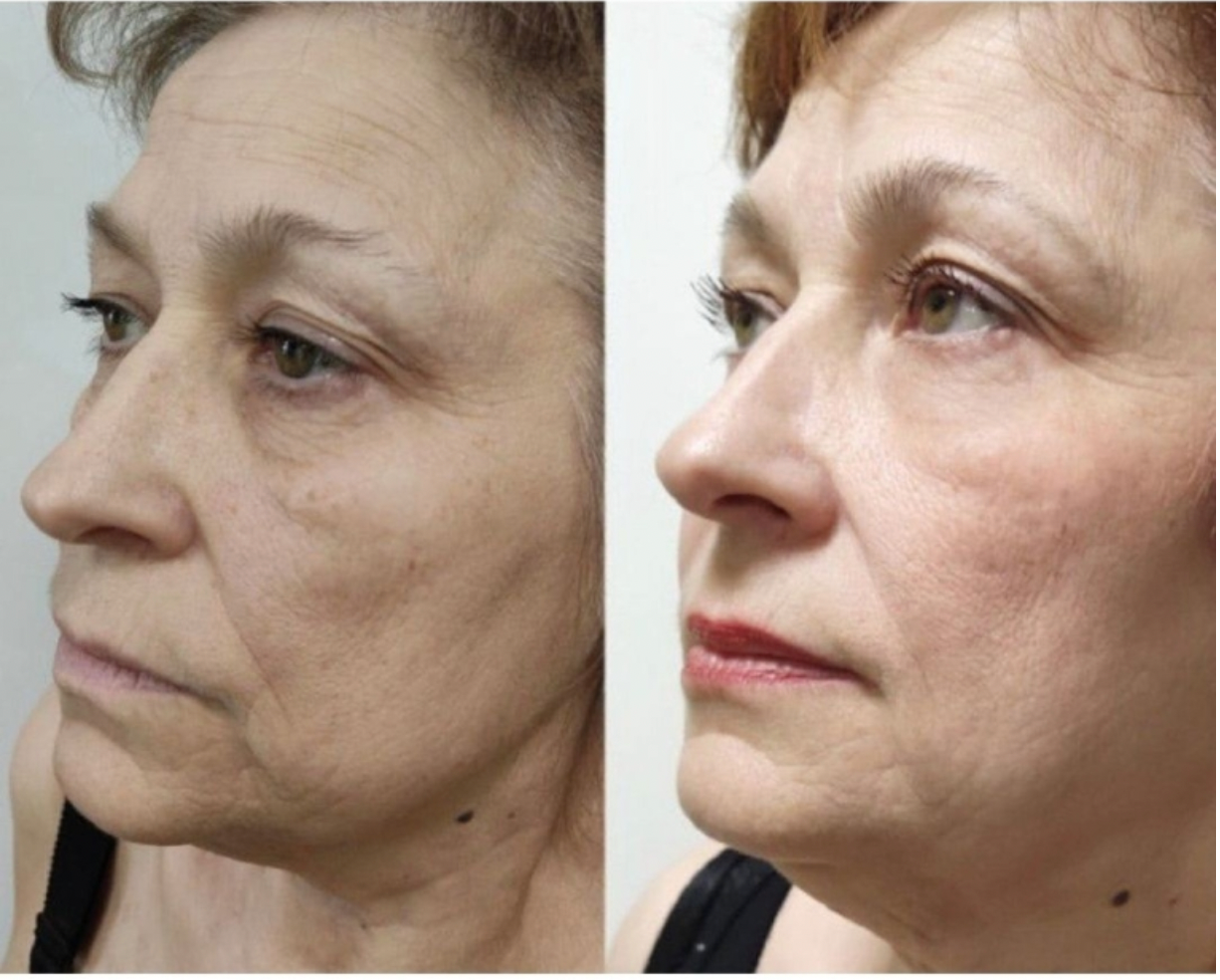 Zemits LumaGenix PDT Perangkat Terapi Cahaya LED Profesional