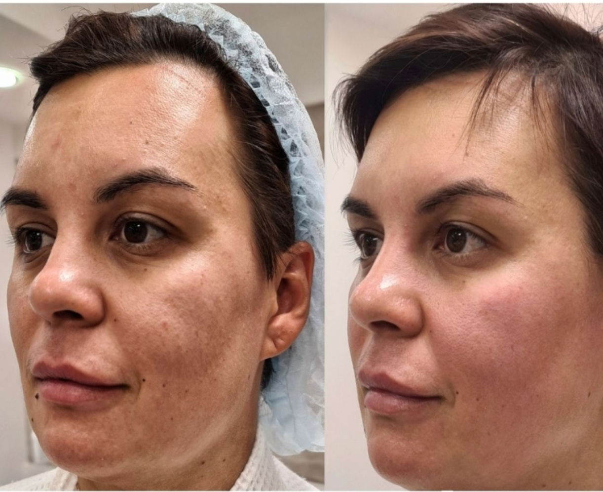 Zemits LumaGenix PDT Perangkat Terapi Cahaya LED Profesional