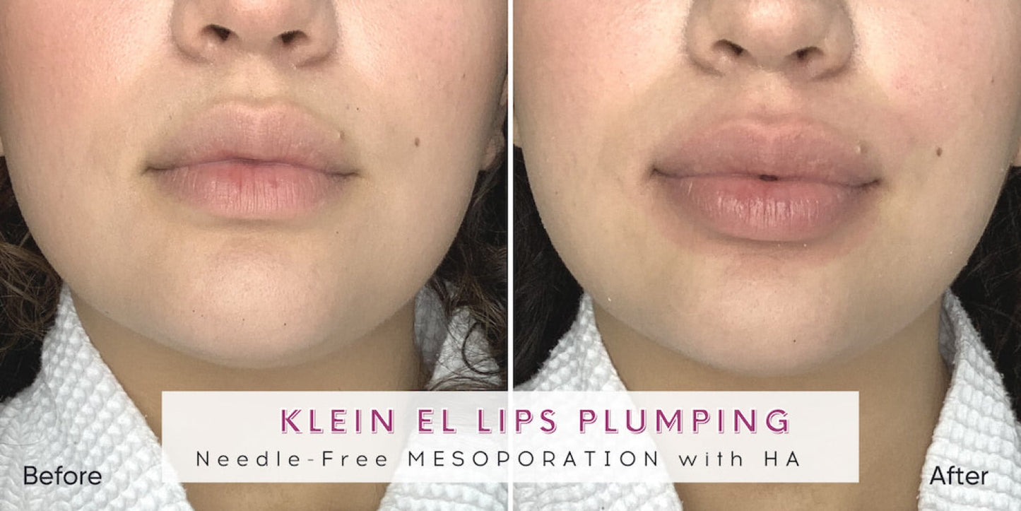 Zemits Klein EL Sistem Elektroporasi