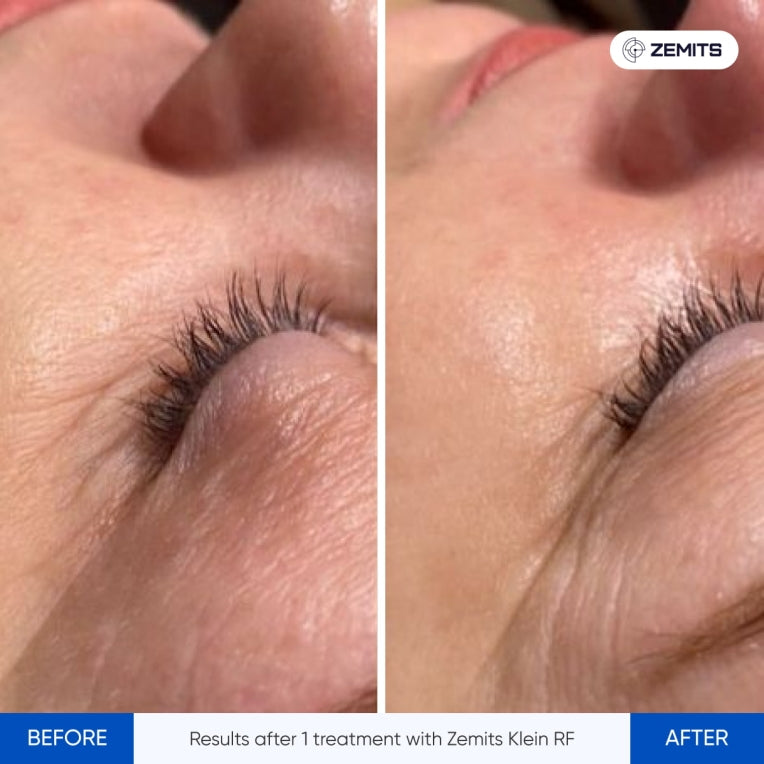 Zemits Klein RF Sistem Pengencangan Kulit