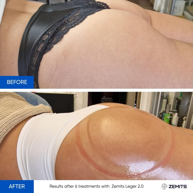 Zemits Leger 2.0 Sistem Cupping Vakum dengan Cangkir XXL dalam Set